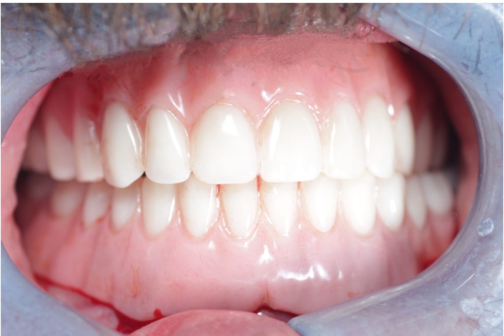 immediate vs permanent dentures