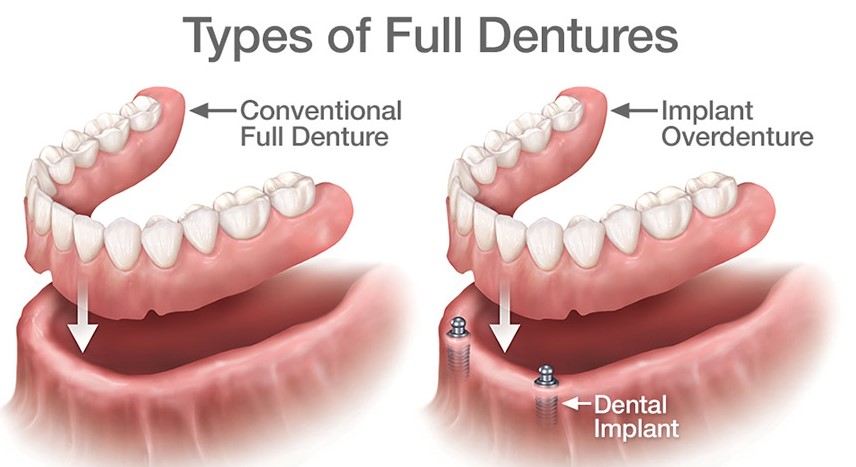 anchored dentures