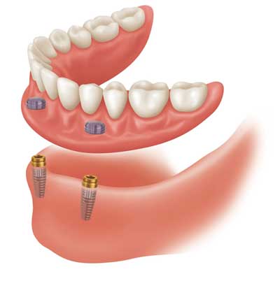 implant anchored dentures cost