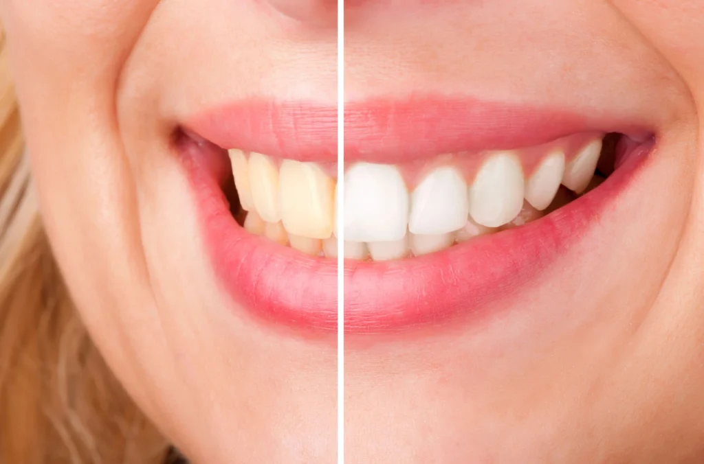 before and after seeing the Best Cosmetic Dentist in Boca Raton