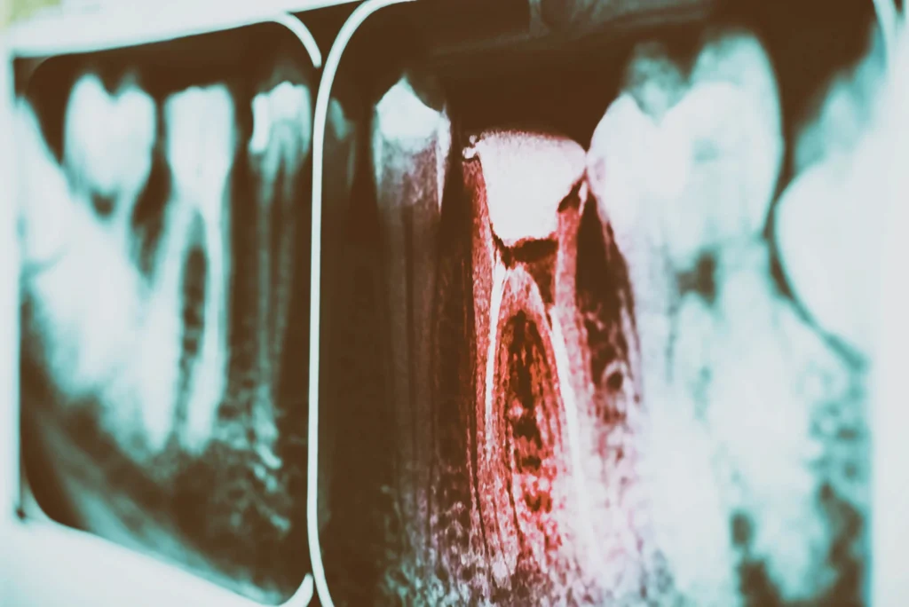 needing-Dental-Crowns-in-Boca-Raton 