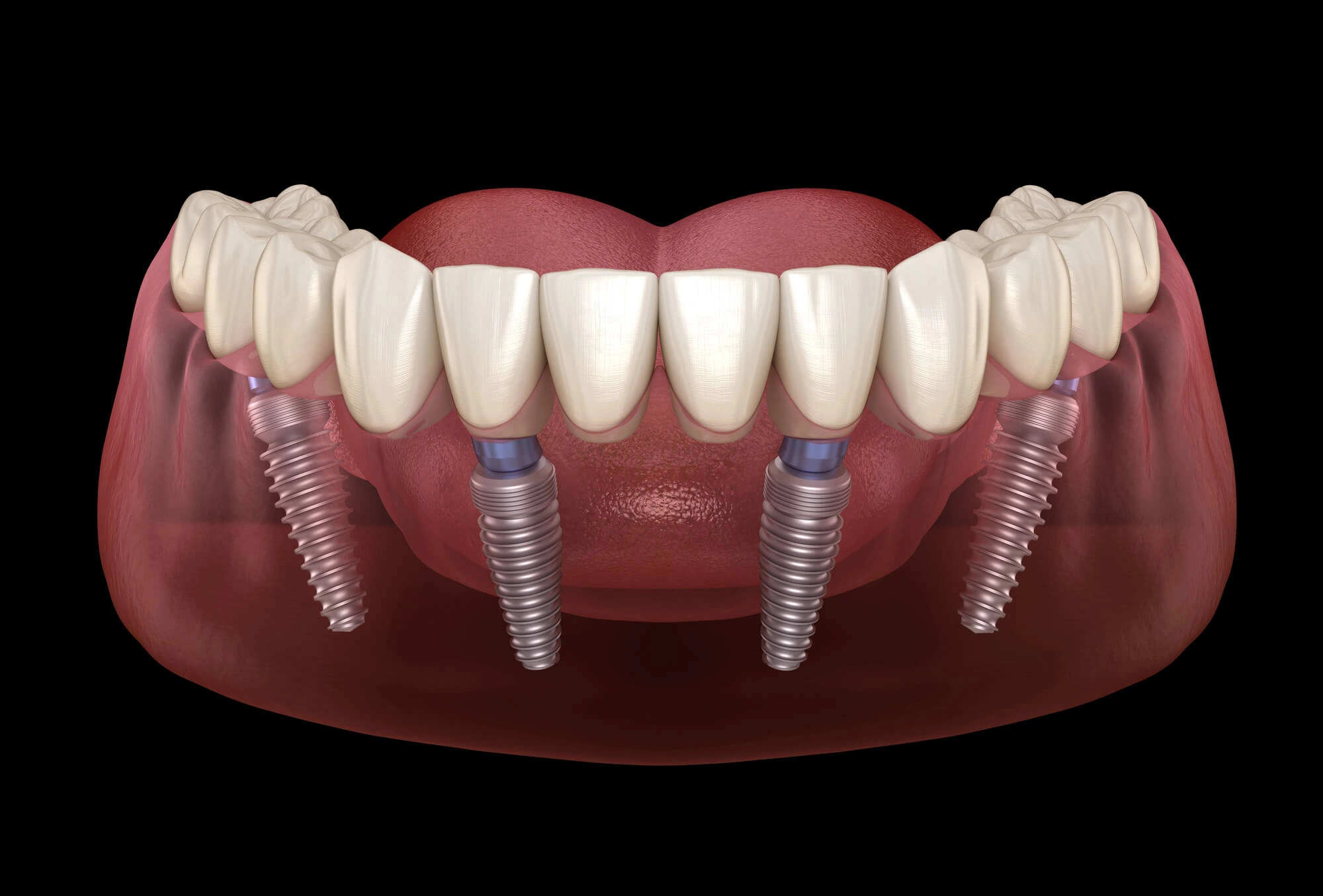3D-illustration-of-all-on-4-dentures-boca-raton