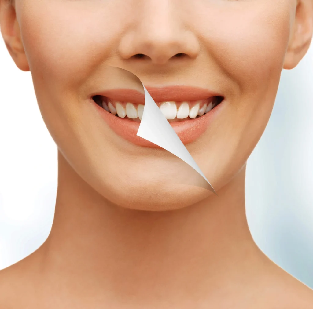 teeth whitening boca raton before and after