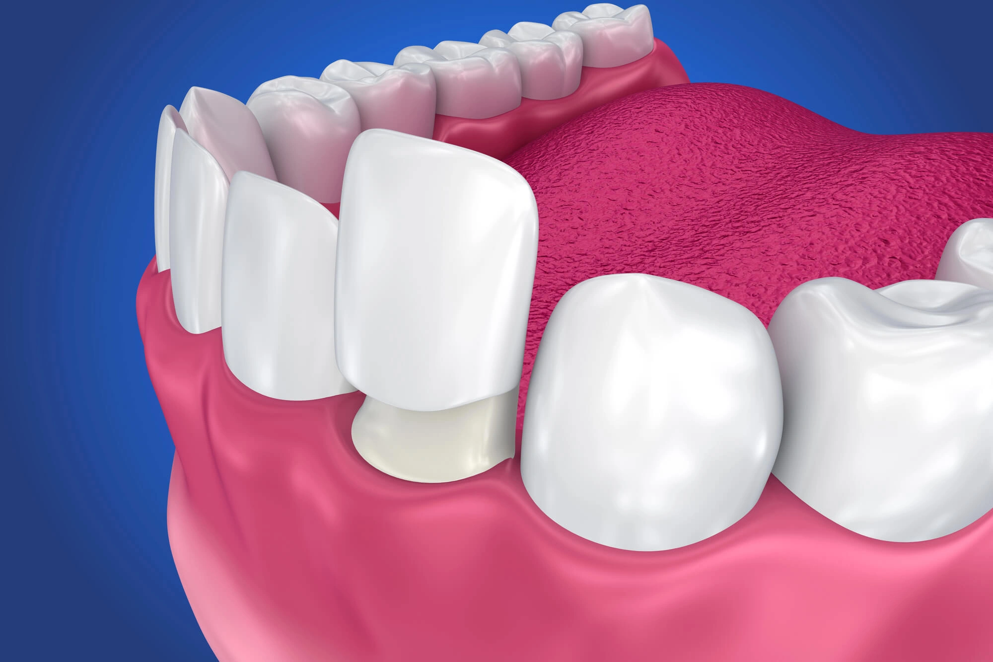 3D illustrationof veneers boca raton