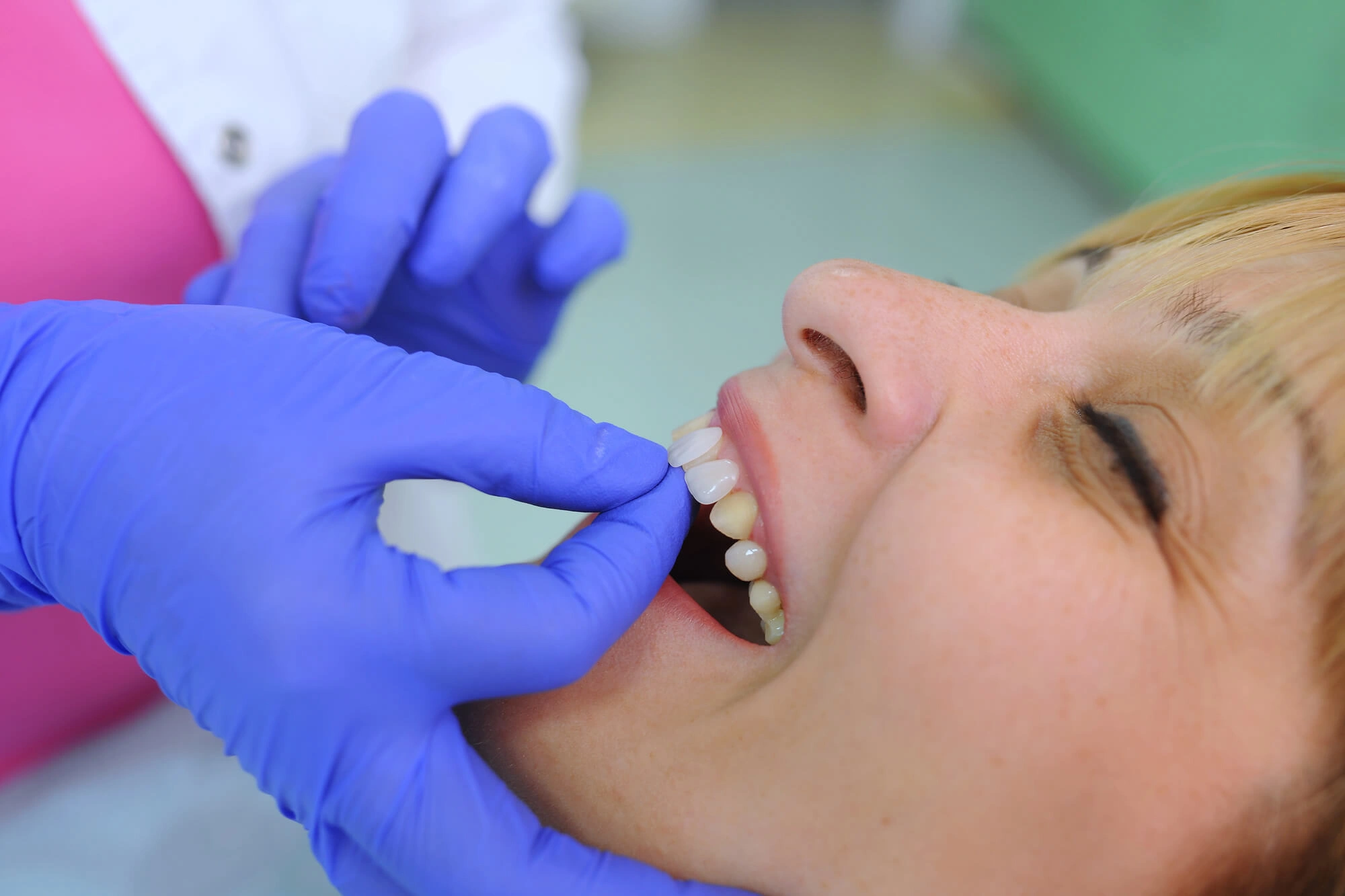 Installation of veneers boca raton