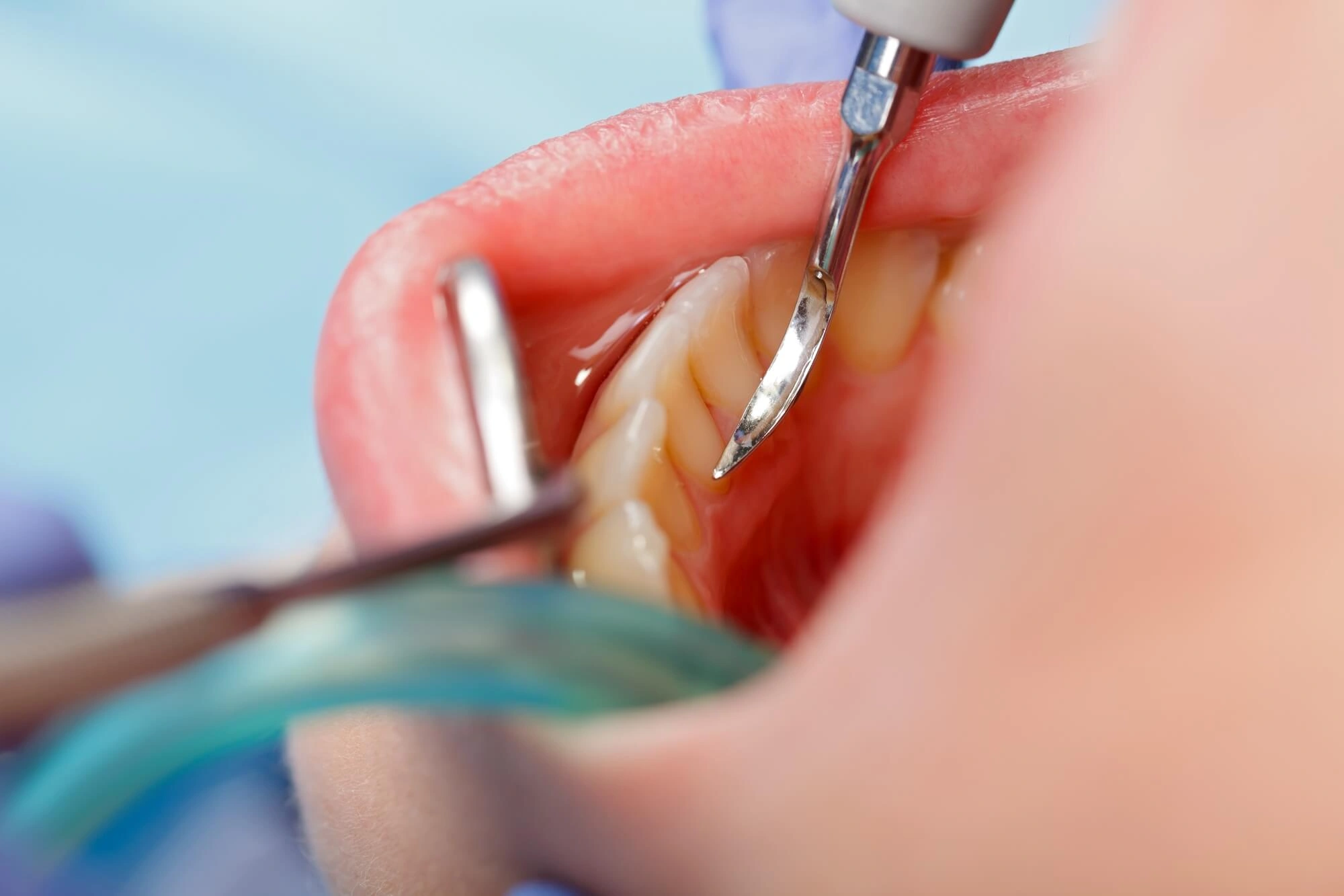dental cleaning boca raton