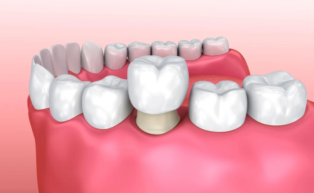 3D illustration of dental crowns boca raton