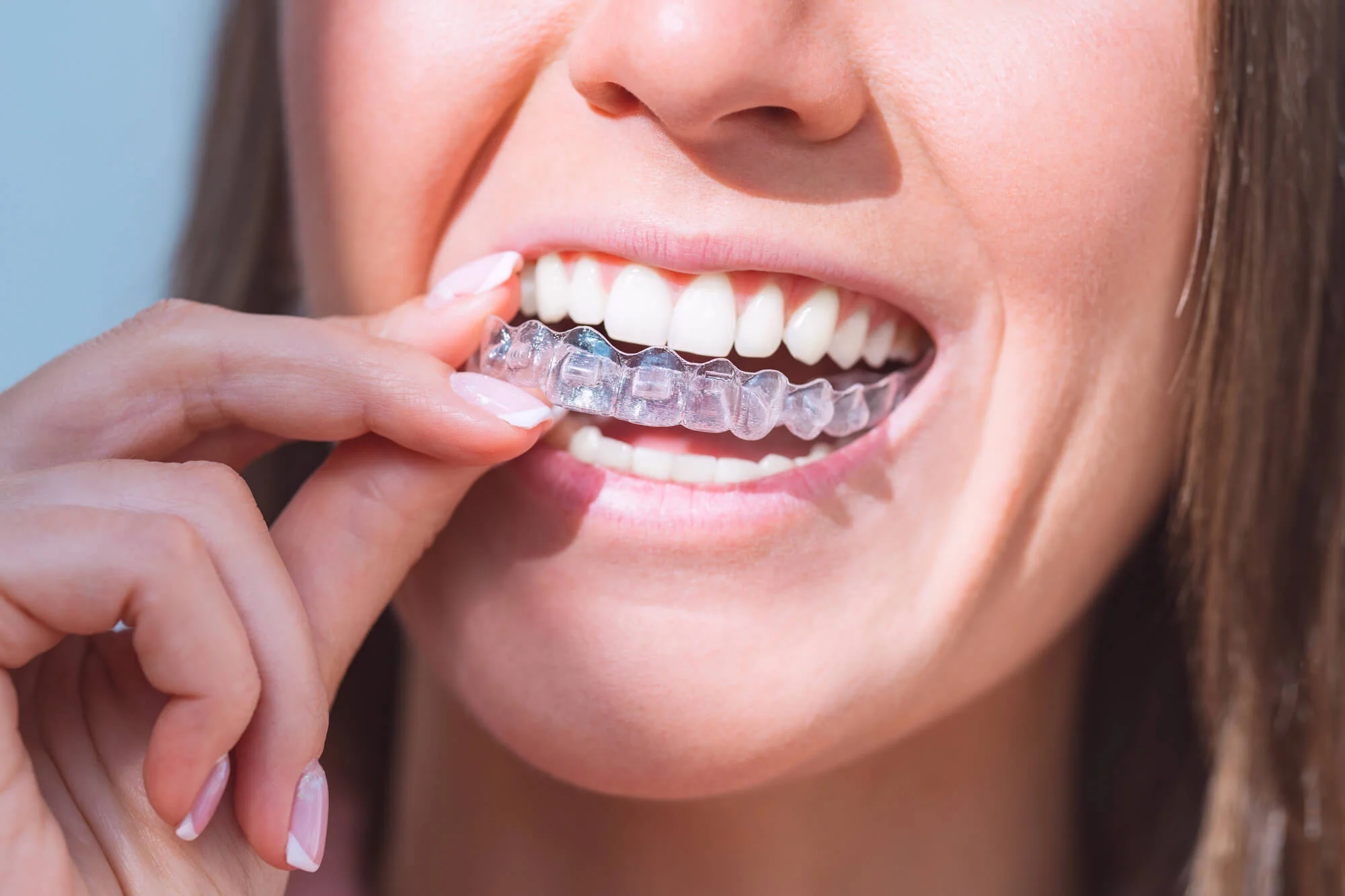 Woman wearing her invisalign boca raton