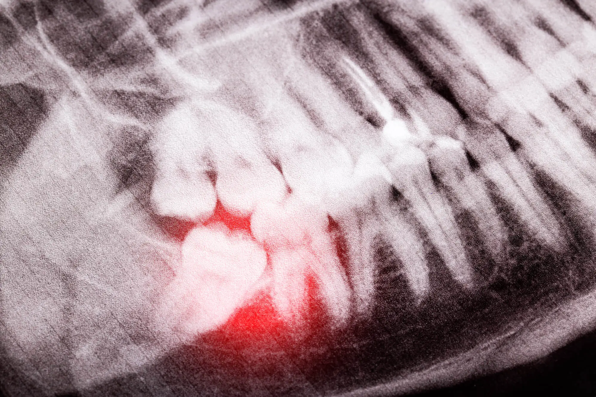 Xray before wisdom teeth removal boca raton