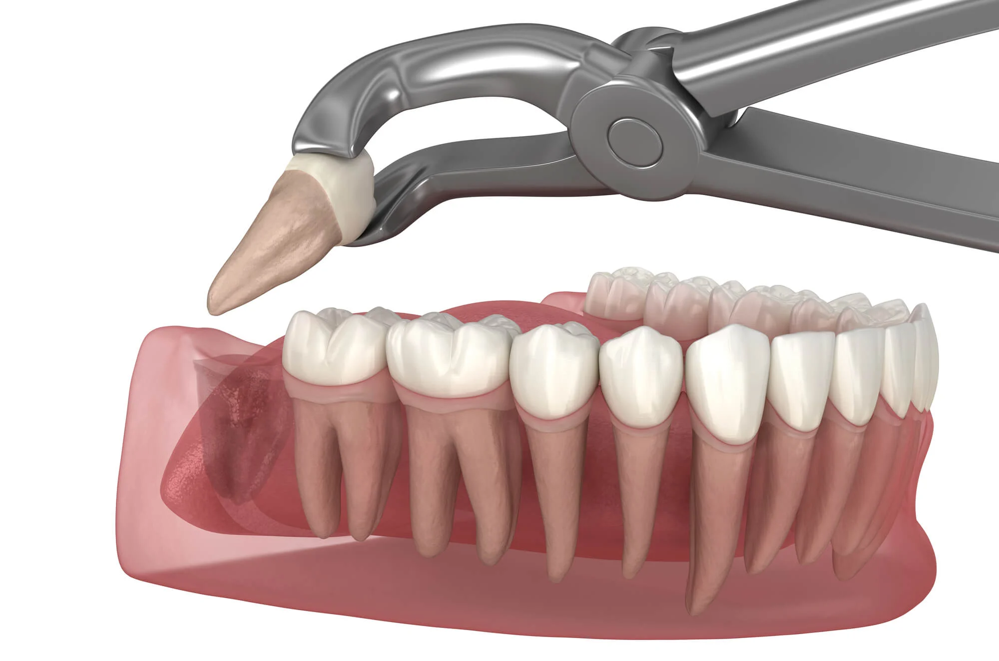 wisdom teeth removal boca raton